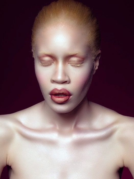 Диандра Форрест - афроамериканка-альбинос