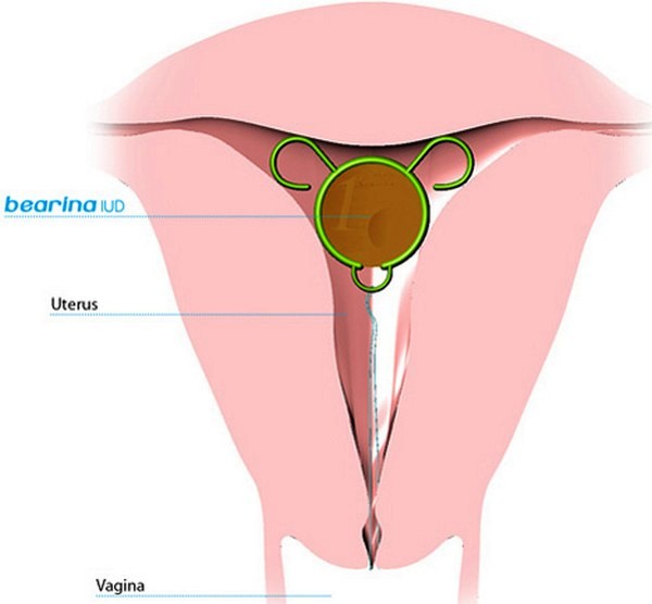 Bearina, концептуальный контрацептив для женщин из монеты в один цент