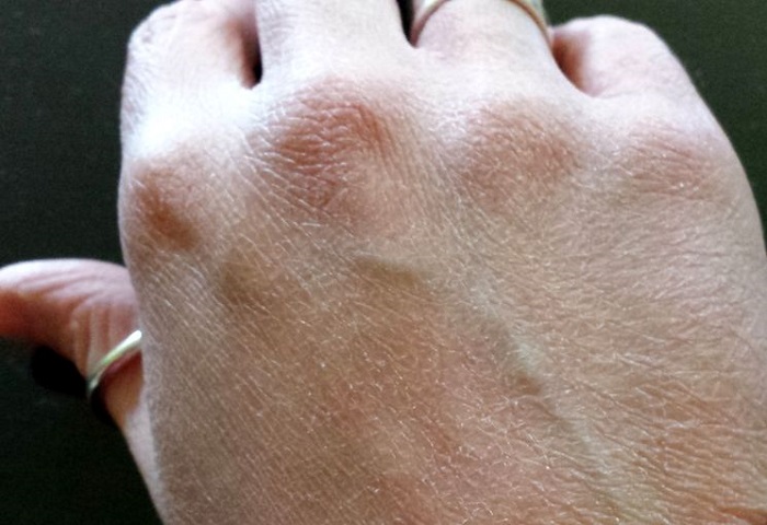 Пересушенная кожа рук начинает шелушиться. / Фото: vokrugsada.ru