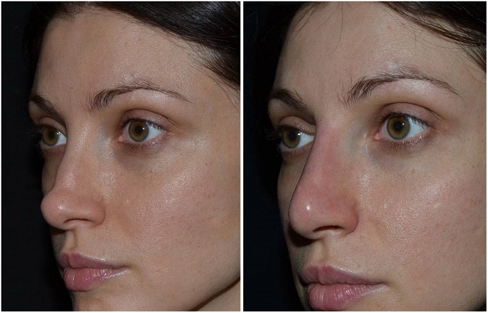 Результат до и после процедуры. / Фото: gerpespro.ru