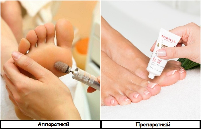 Для препаратного педикюра используют средства с кислотами . / Фото: balabolkina.ru