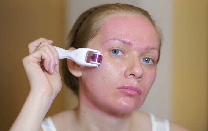 Дермароллером можно сильно надавить на кожу и повредить ее. / Фото: womendomain.ru