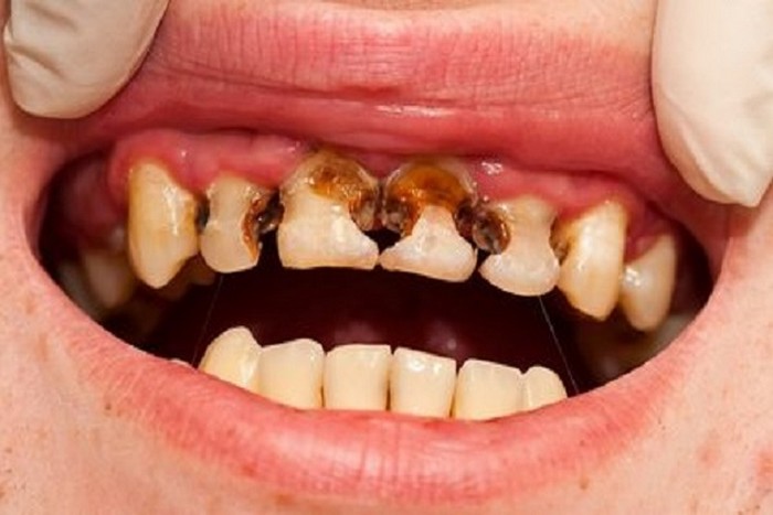 Любитель колы – кошмар стоматолога