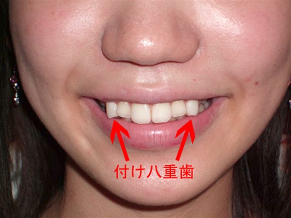 Модные кривые зубы Yaeba становятся всё более популярными среди японской молодежи
