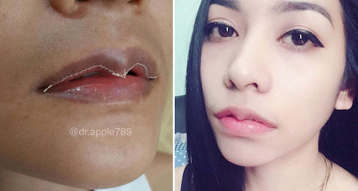 Уменьшение губ – новый тренд с истоками в Азии. 