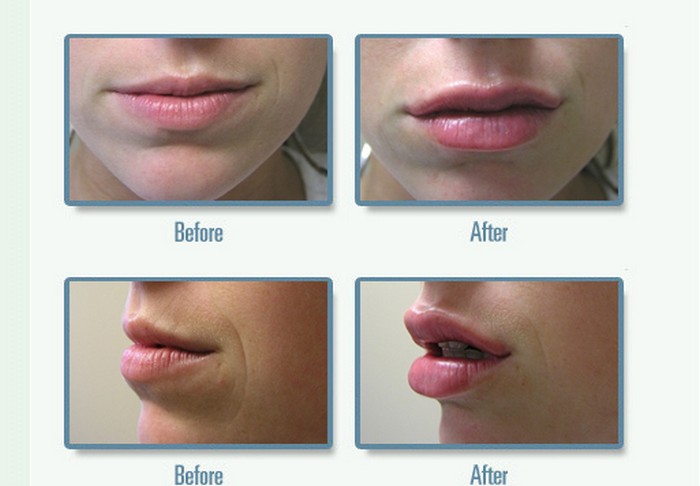  Бюти-советы: 11 способов увеличить губы без уколов и операций 