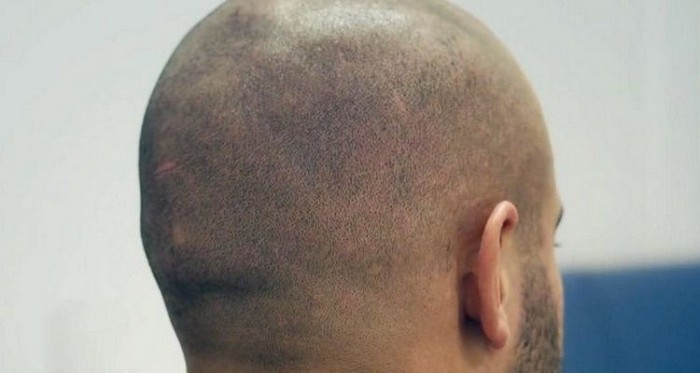 Микропигментация или микротатуаж кожи головы: новый тренд в борьбе с облысением