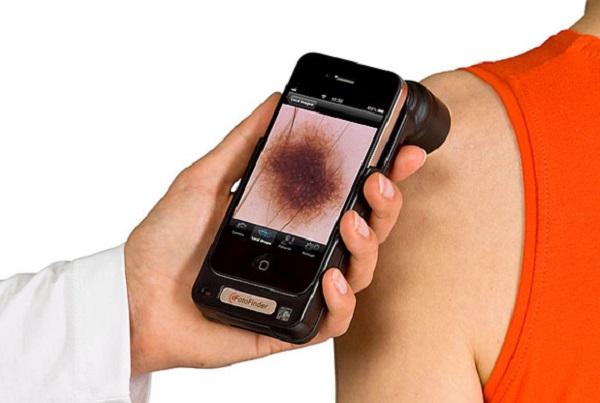 Приложение для смартфонов для диагностики рака кожи.
