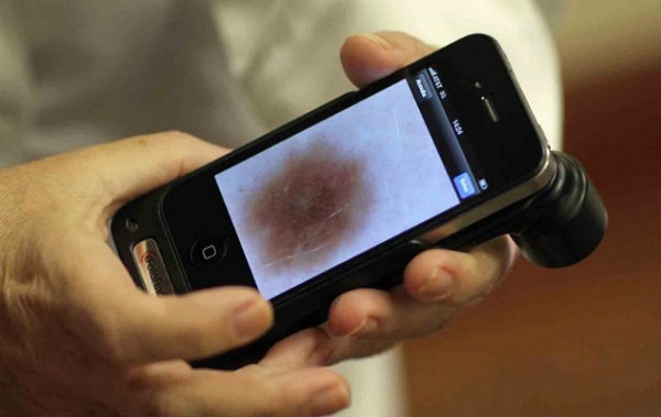 Приложение DermoScreen для диагностики рака кожи.
