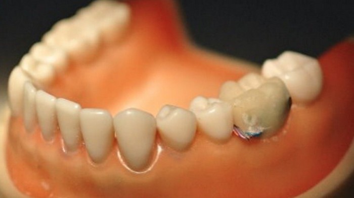 Smart Tooth – умные зубы против обжорства и курения