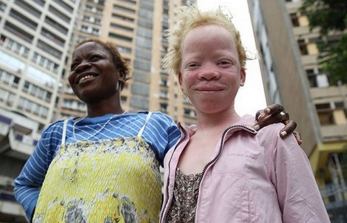 Невоможно уменьшить симптомы альбинизма.