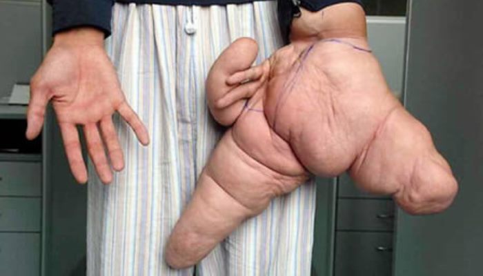Рука человека с редким заболеванием макродактилия.