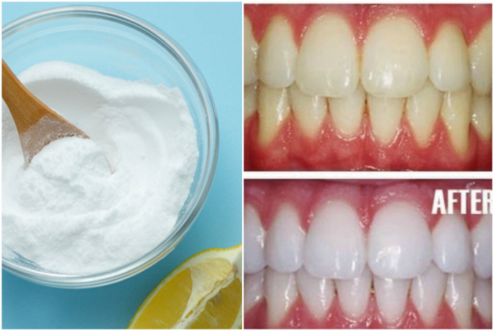 отбеливание зубов содой отзывы стоматологов