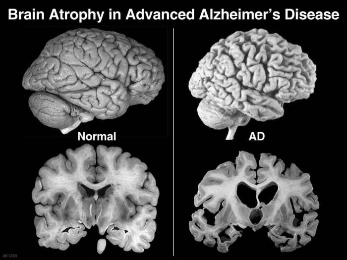 Болезнь Альцгеймера.
