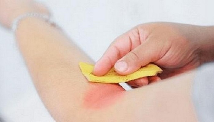 Банановая кожура поможет успокоить зуд от укусов комаров.