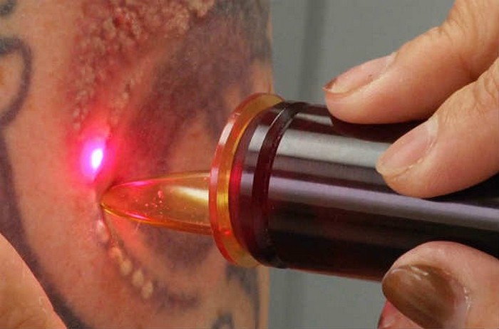 Лазер для удаления татуировки