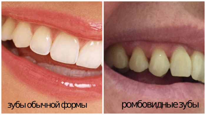 При ромбовидных зубах зубная нить – ежедневный товарищ.