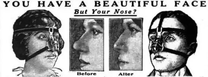 Сто лет назад форму носа корректировали таким образом. /Фото: techinsider.ru