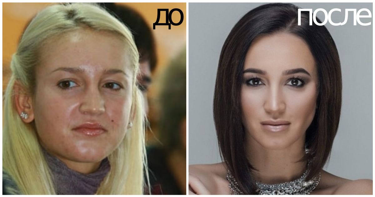 Алина алексеева фото до и после пластики